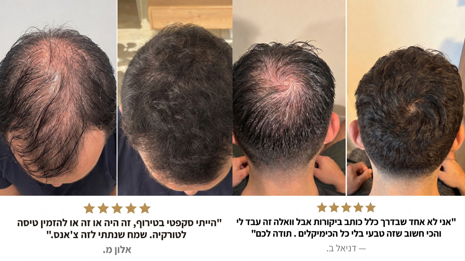 נשירה גנטית: למה אבא שלך מקריח, ומה אתה יכול לעשות לפני שזה קורה גם לך