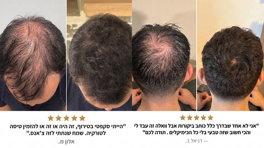 נשירה גנטית: למה אבא שלך מקריח, ומה אתה יכול לעשות לפני שזה קורה גם לך