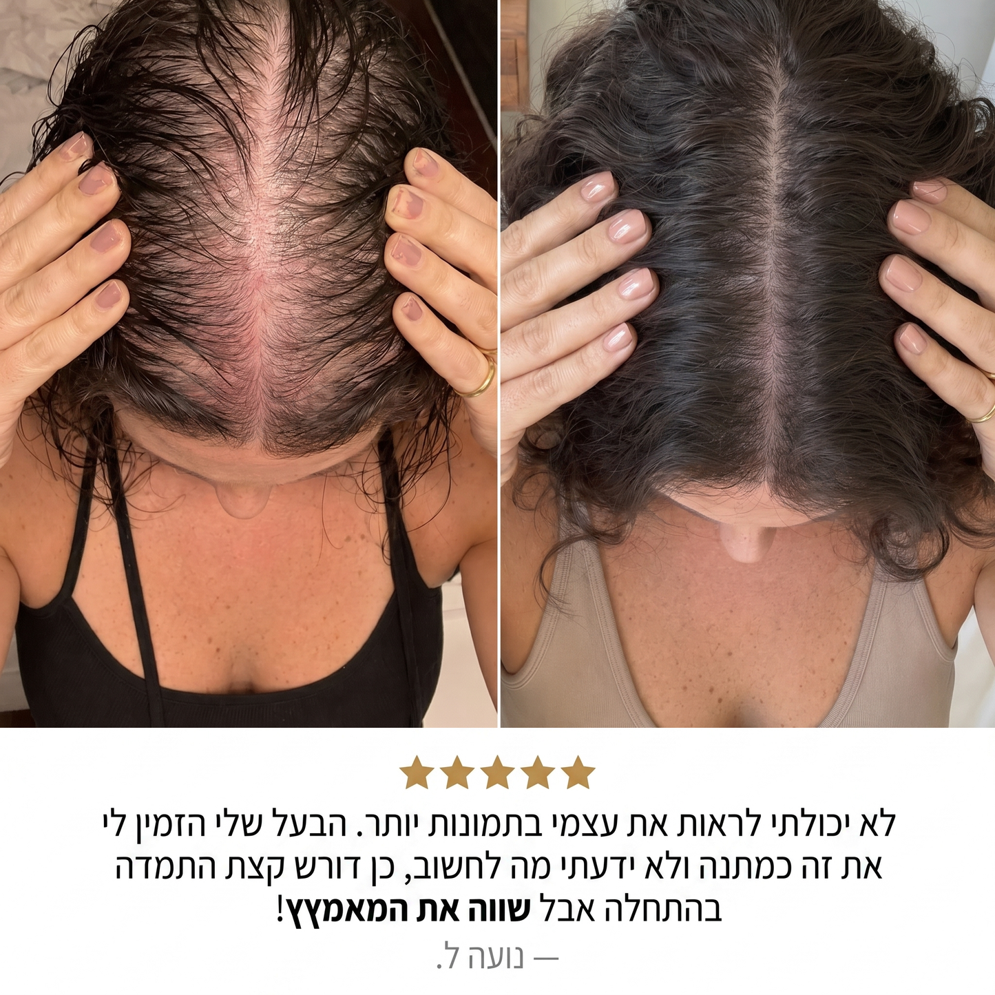 RootFix™ | ערכה לטיפול בנשירה והתקרחות של השיער