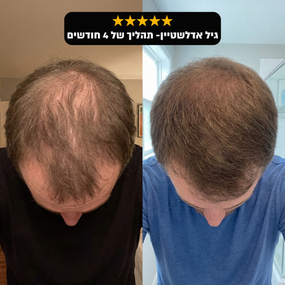 RootFix - ערכה לטיפול בנשירה והתקרחות של השיער