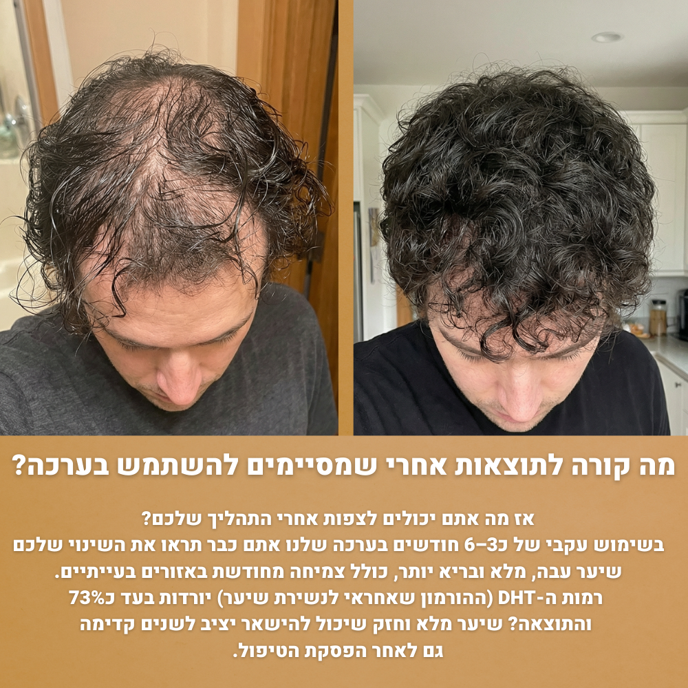 RootFix™ | ערכה לטיפול בנשירה והתקרחות של השיער