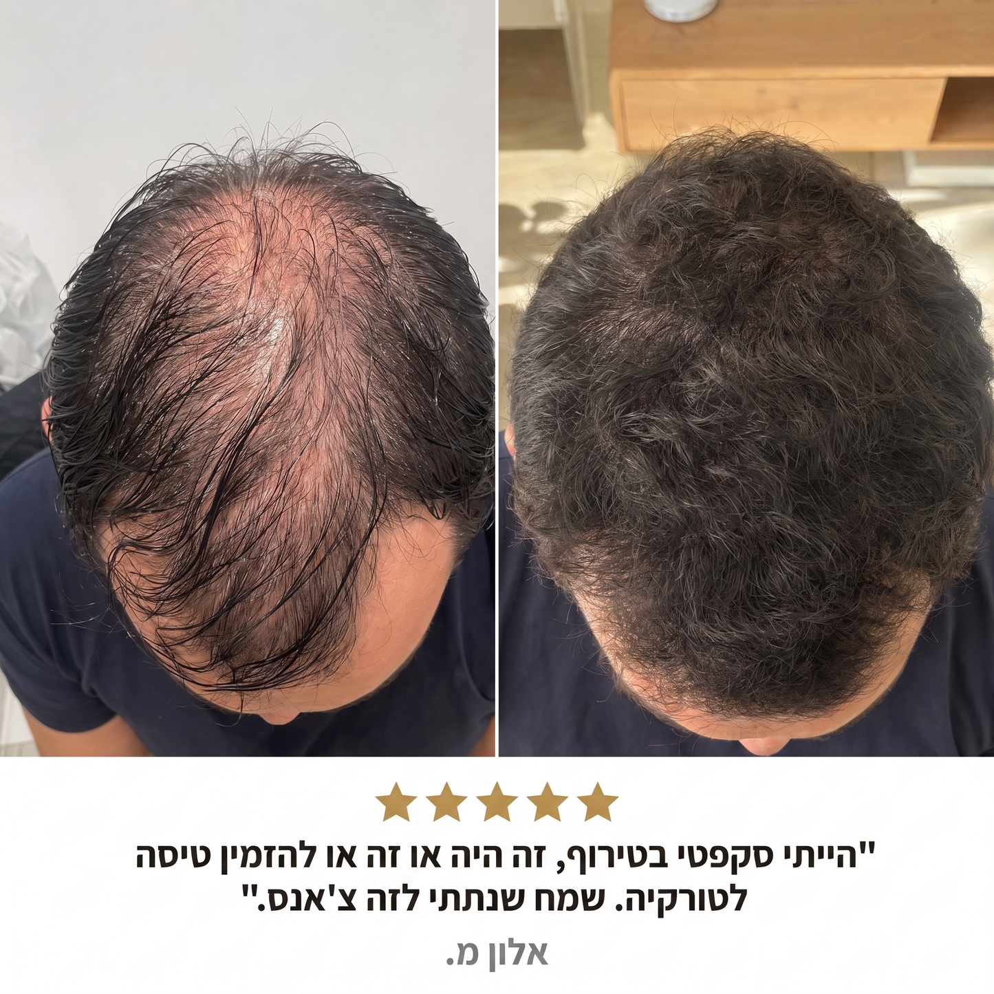 RootFix™ | ערכה לטיפול בנשירה והתקרחות של השיער