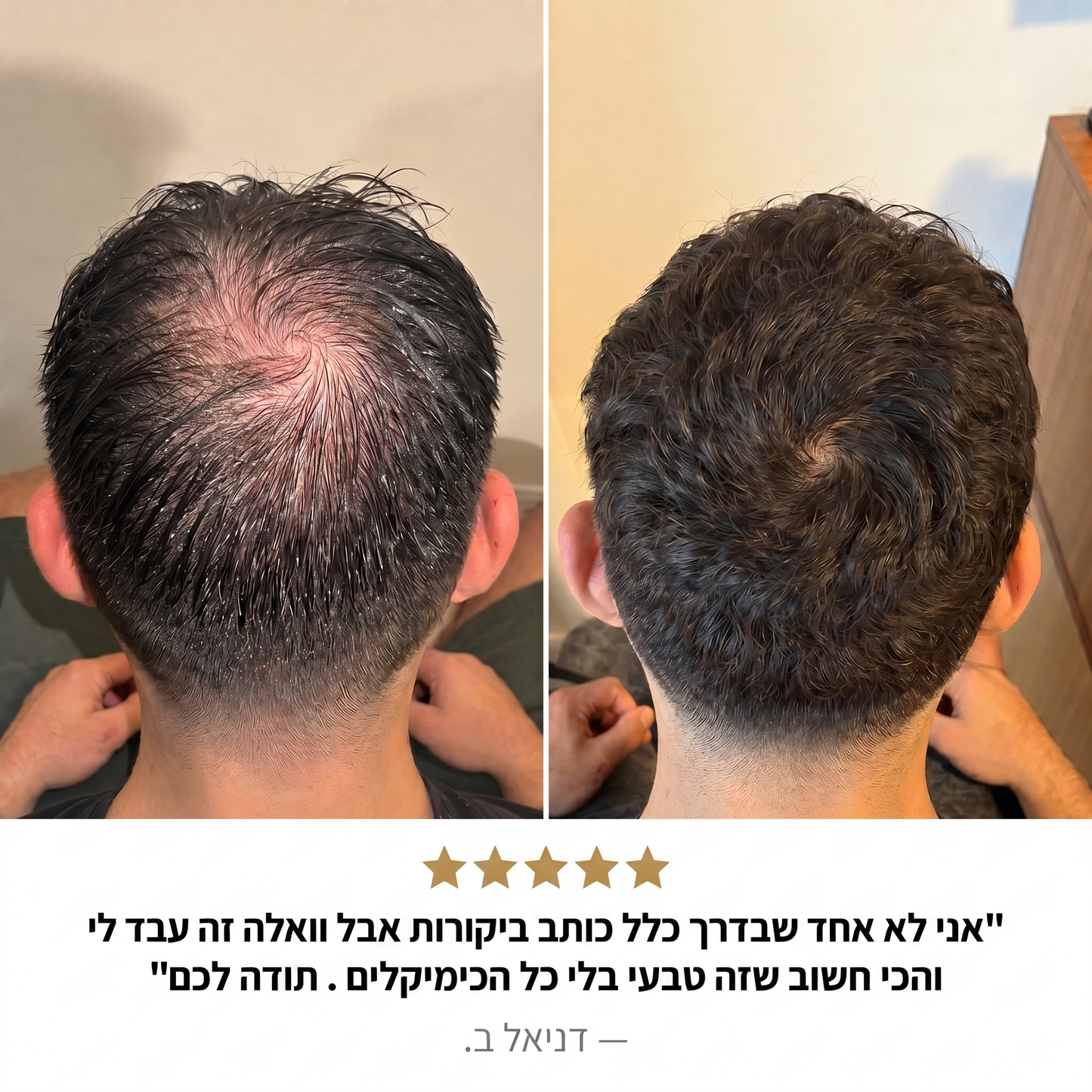 RootFix™ | ערכה לטיפול בנשירה והתקרחות של השיער